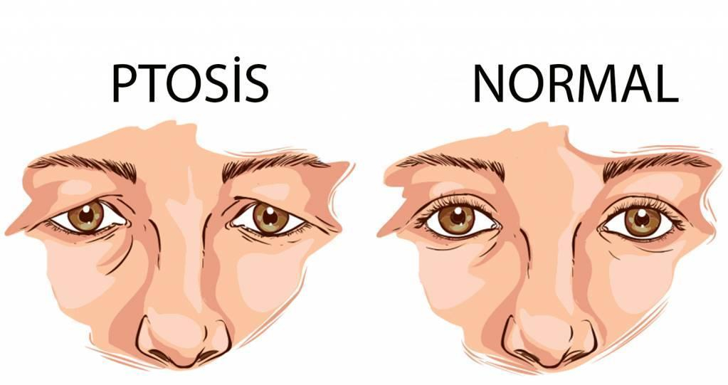 Kontakt Lensler ve Ptosis